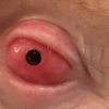 Como é a cirurgia dente-no-olho